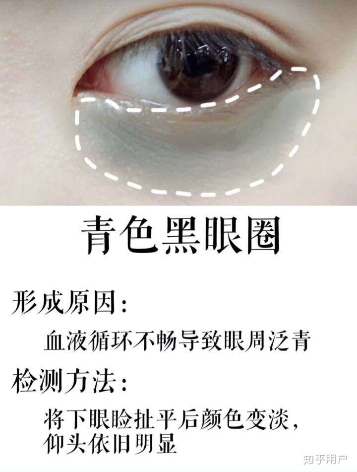 怎样把黑眼圈消掉?