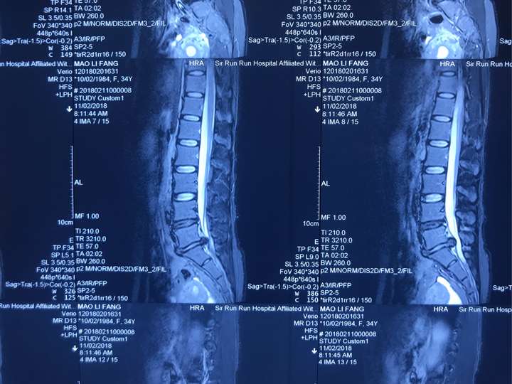 腰椎间盘突出手术后的生活是一种怎样的体验?