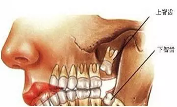 智齿的生长原因是什么?