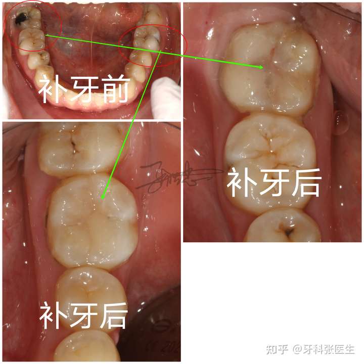 三,可复性牙髓炎 这种伤到牙本质深层了,非常接近牙神经,使牙髓充血