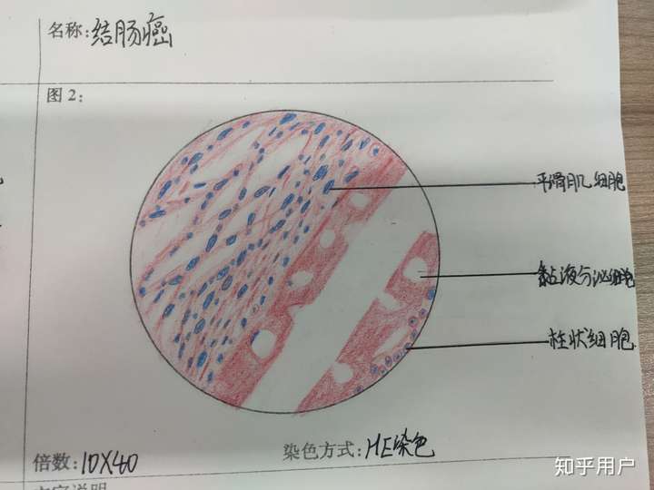 有没有人有病理的结肠腺癌红蓝铅笔手绘图啊?