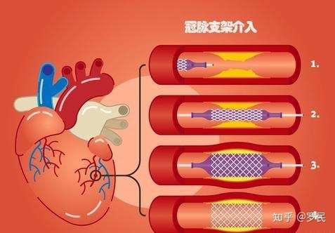 冠心病支架一年半了怎么偶尔还会心绞痛