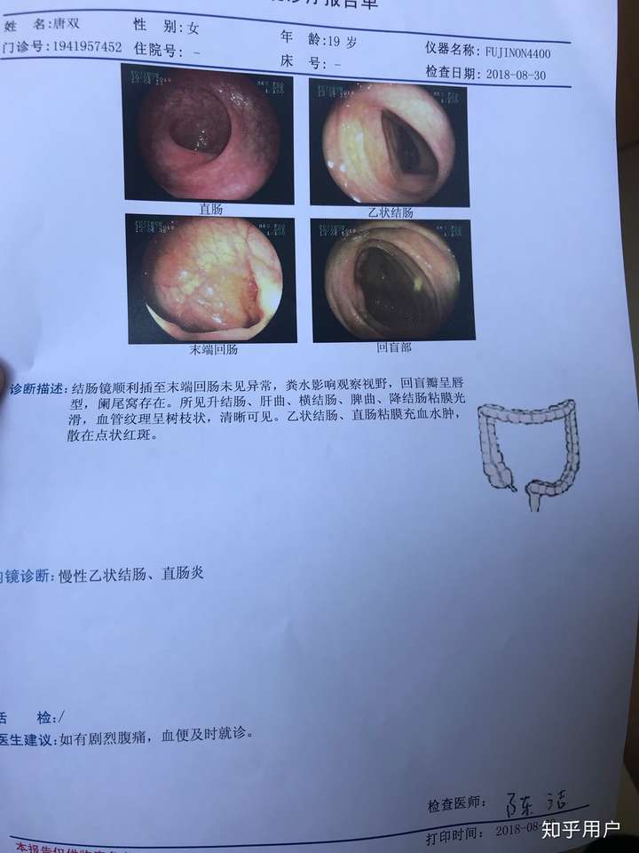 有没有人得过慢性直肠炎,治了一年多了反反复复治不好,十八岁的我心态