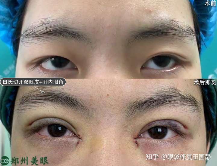 男生如果想割一个偏内双的双眼皮,相对于正常双眼皮,恢复的可以相对更