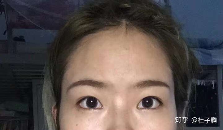 你说成功了吧 确实眼头双眼皮割得比眼中眼尾宽多了 显老 而且做的