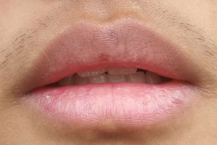 嘴唇黑紫用什么东西可以改善?
