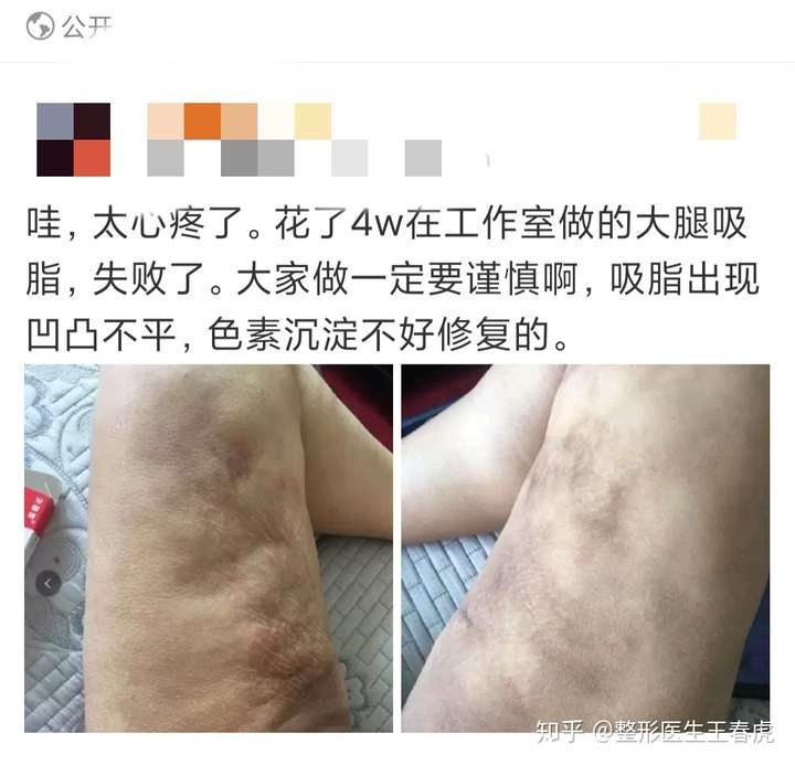 吸脂有哪些危害和后遗症?