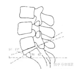 ube骶椎腰化腰椎骶化腰椎滑脱腰肌劳损简单易懂图解医术苑