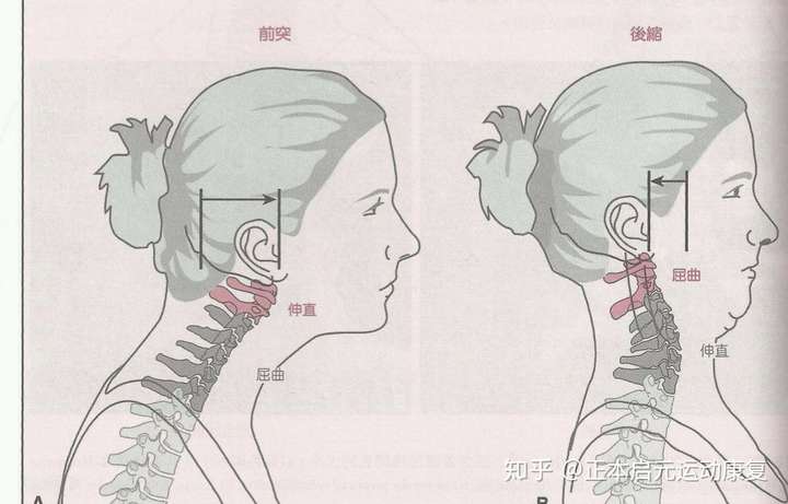 肩膀上和颈椎处有一个好大的富贵包怎么去除?