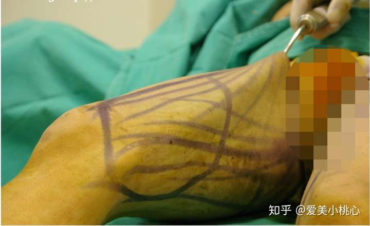 达到 局部塑形作用