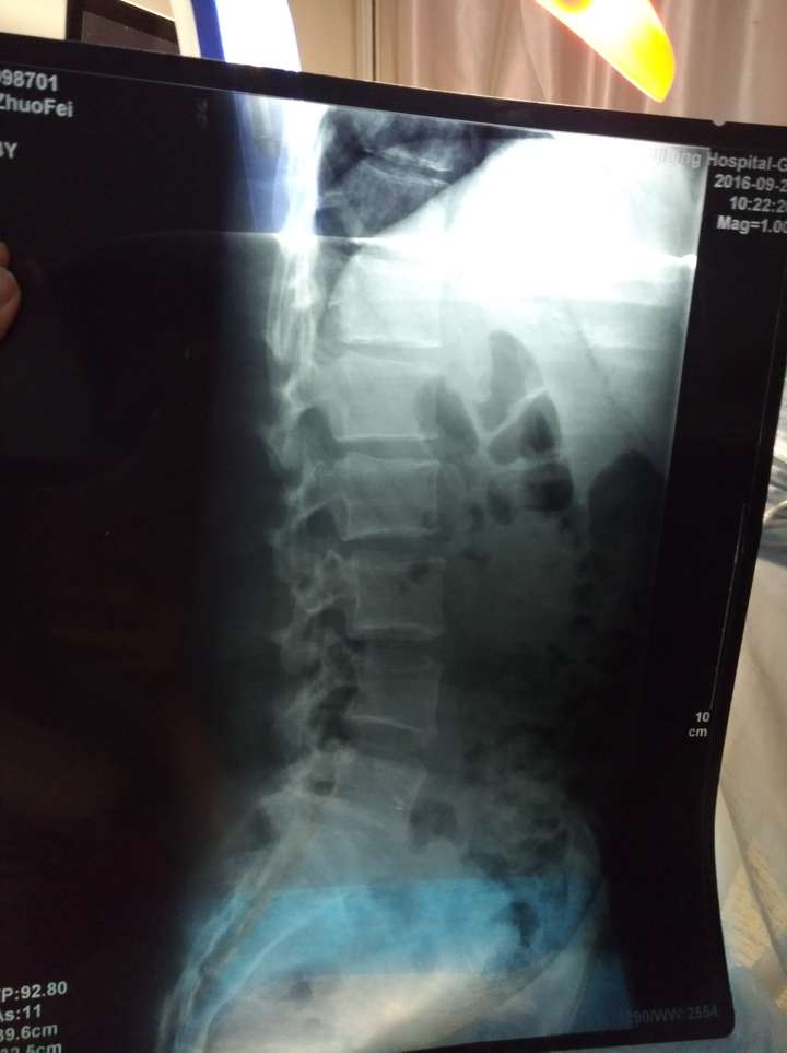 站姿腰椎颈椎.    骶髂关节平扫ct. 以及昌平大夫让我拍的躺姿骨盆.