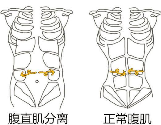 随着孕妈妈体内激素的变化,腹直肌中间的这条线——腹白线,会慢慢发生