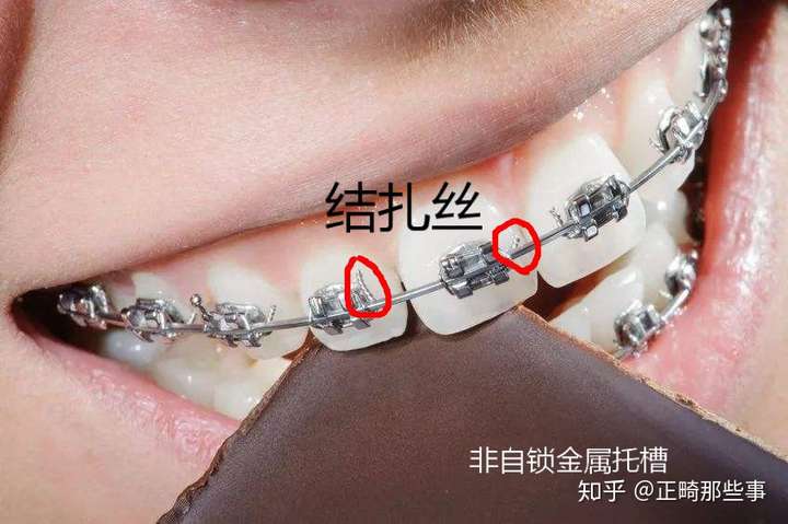 【非自锁金属牙套】 是最传统的牙套,它需要用结扎丝将托槽和弓丝