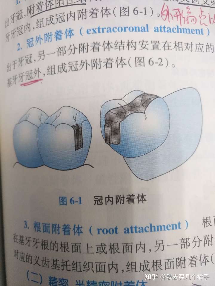 口腔修复学里的冠内固位体的外形线是什么啊?