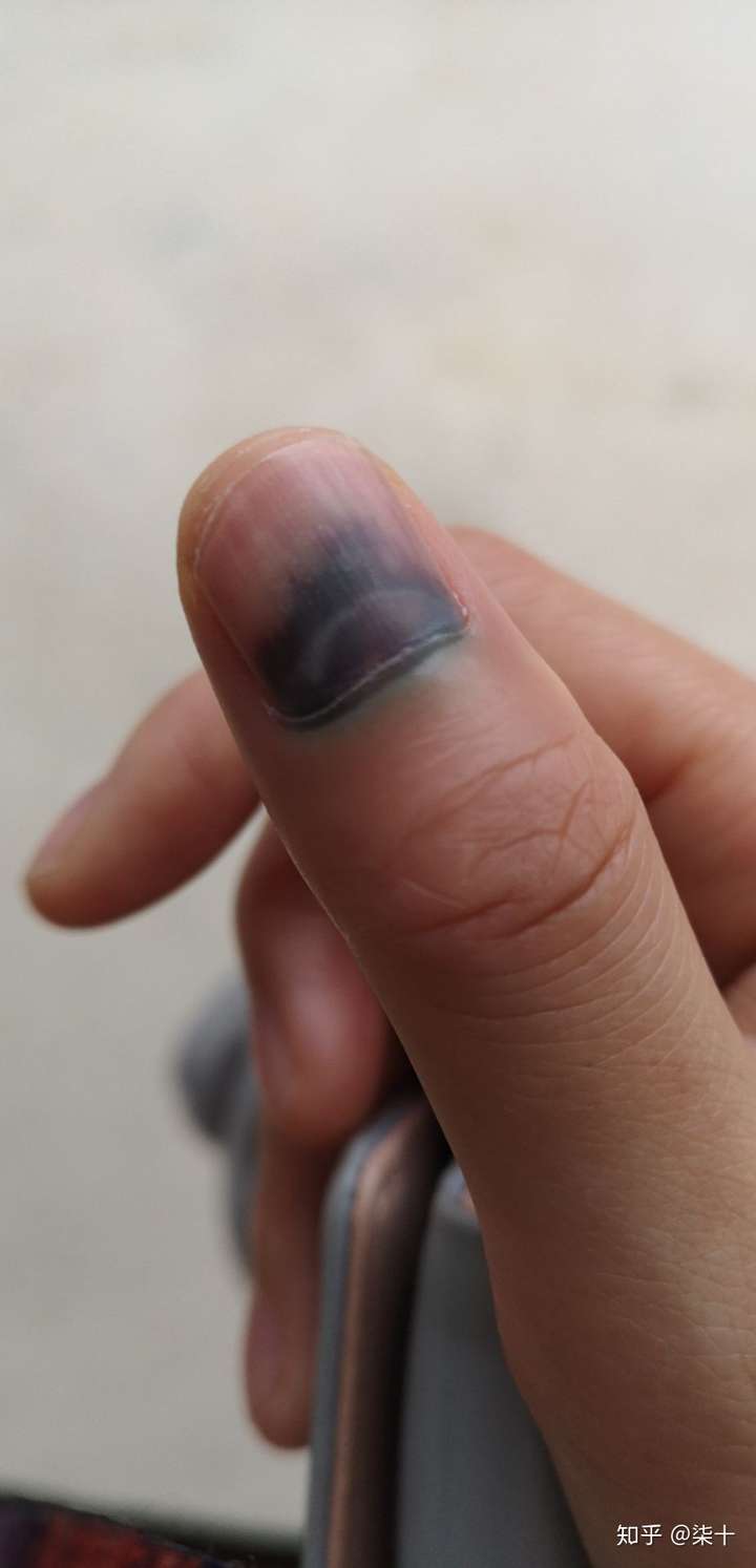 手被车门夹了怎么办?