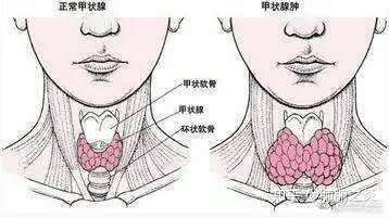 甲状腺检出结节了,需要看医生吗?