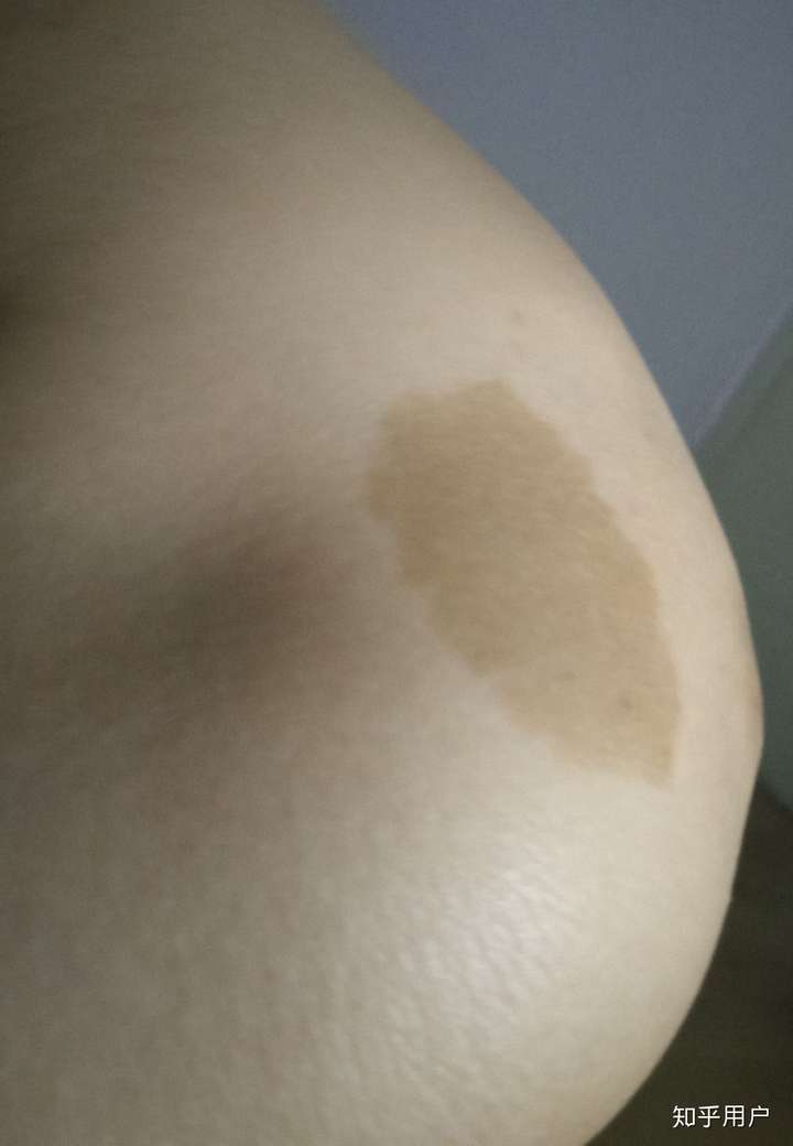 你见过什么特殊的胎记?