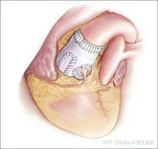 浙江省人民医院崔勇医生:心脏瓣膜修复手术术后注意事项