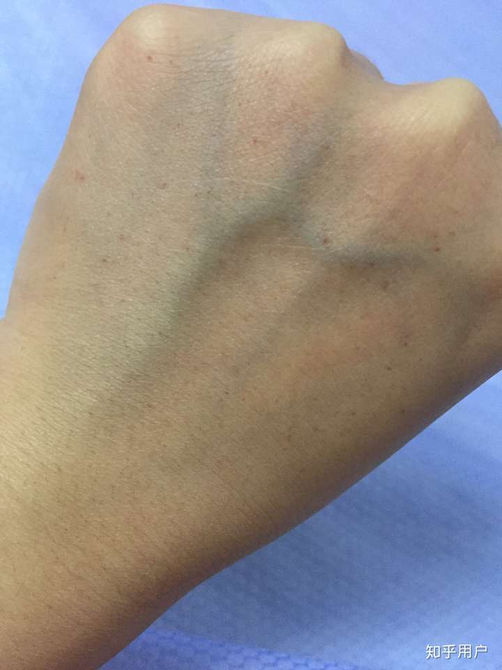 左手手背长红点?