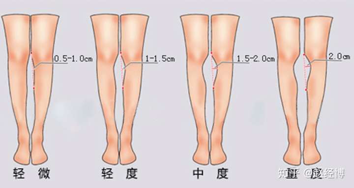 腿不直(o型腿)可以通过医疗矫正吗?