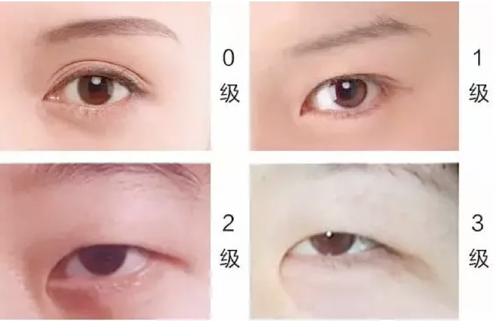 我是内眦赘皮吗?需不需要开眼角和割双眼皮?