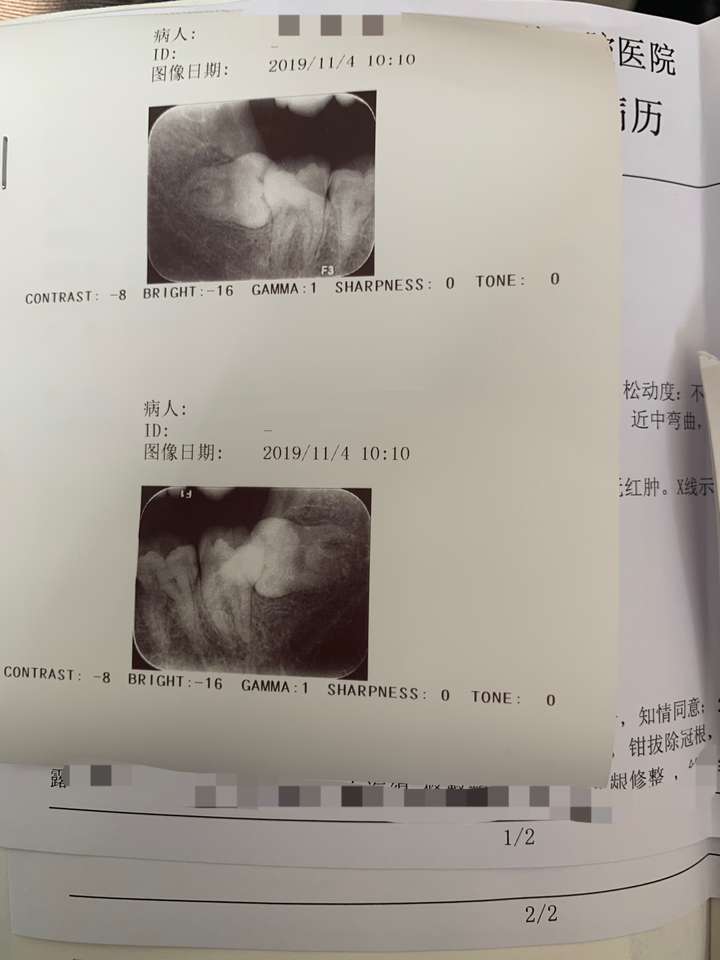 拔完智齿你的脸肿了吗?