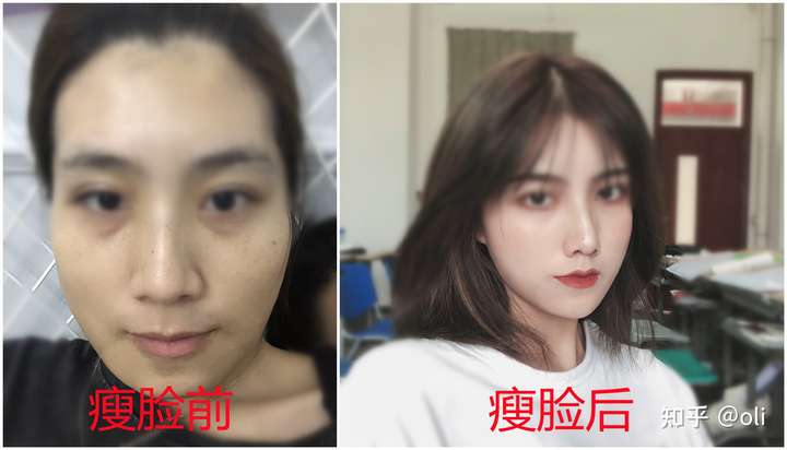 瘦脸针,玻尿酸别轻易打 因为…… 因为效果太惊人了!