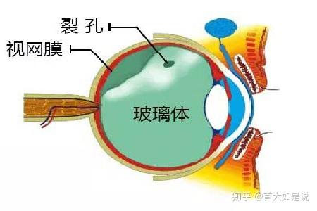 首大聂红平:玻璃体后脱离会失明吗