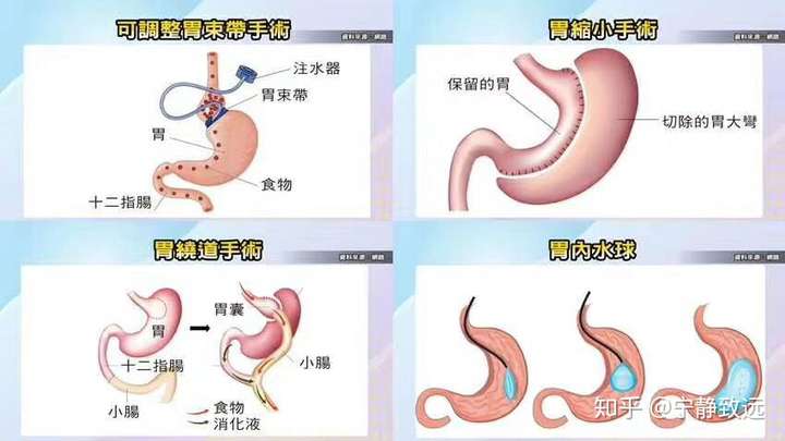 如何判断自己是否适合外科减重手术?想缩胃的胖胖必看