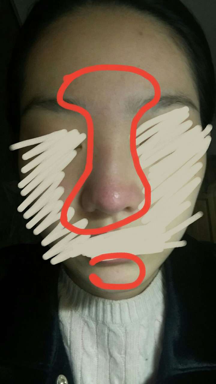 鼻子上老是发红很久了还有痘痘 谁能救救我?