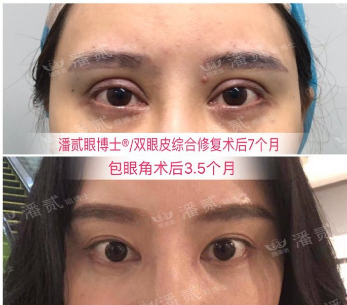 开眼角会不会有后遗症
