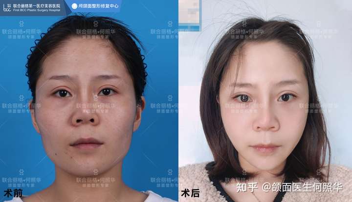 可惜亚洲人普遍五官扁平,如果颧骨太高,会显得中面部很突兀.