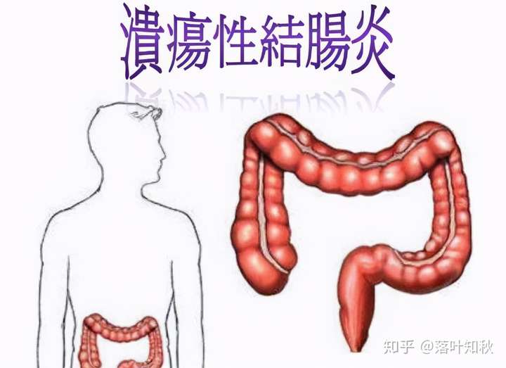 落叶知秋 得了溃疡性结肠炎是非常痛苦的,腹痛,腹泻脓血便经常发生