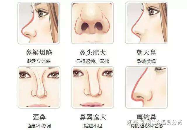 鼻孔太大怎么办?
