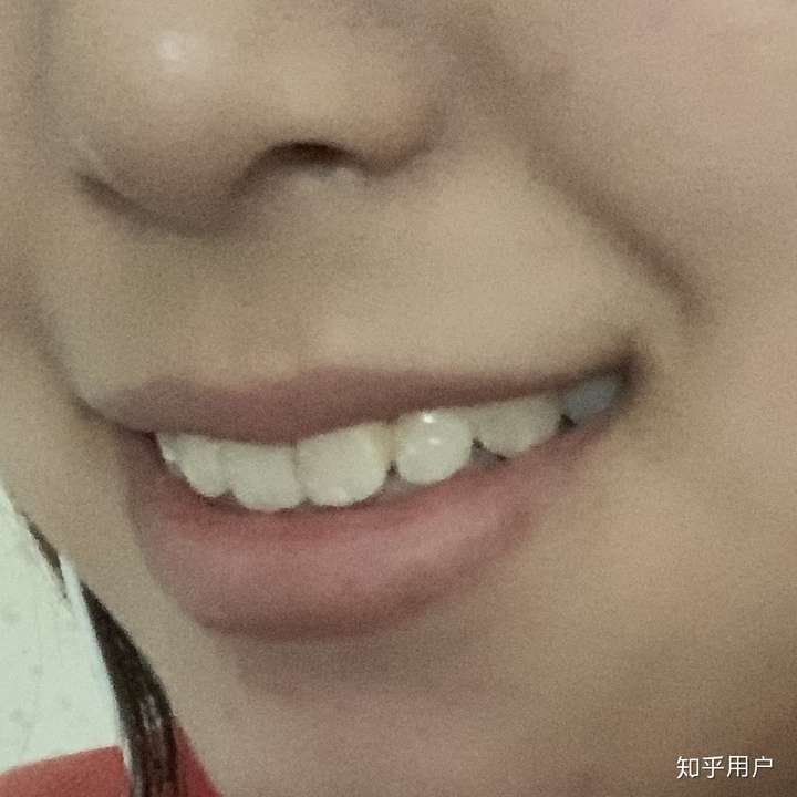 整牙失败是一种什么样的体验?