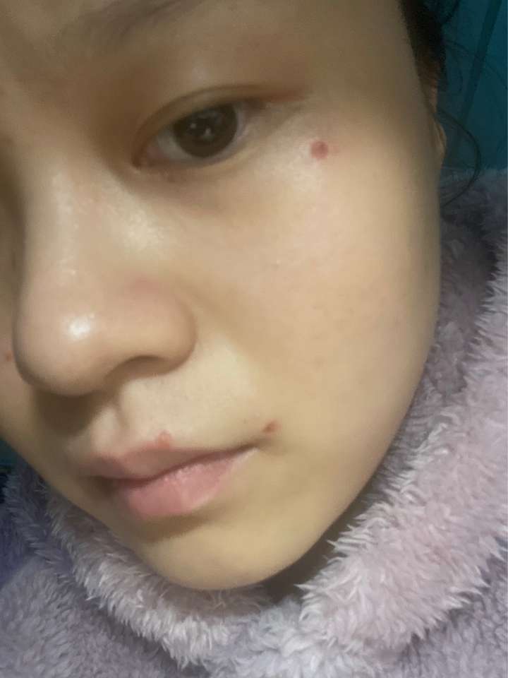 到这里已经开始后悔了,不想照镜子,看着这么大的疤,心情很复杂.