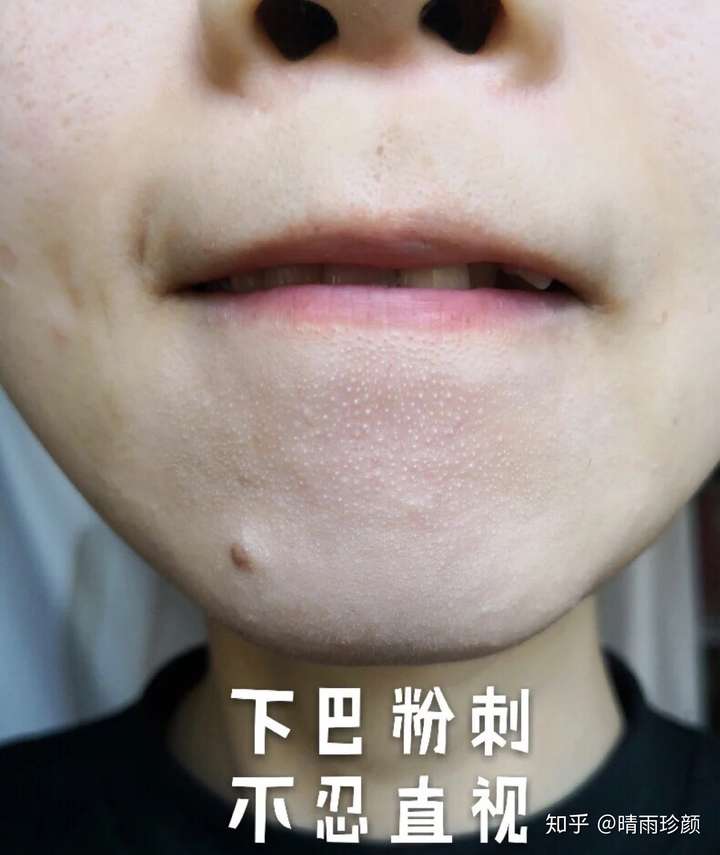 下巴反复长闭口,一大排密密麻麻还凸起怎么办?