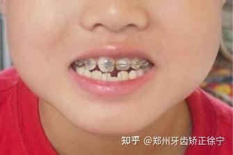 郑州儿童牙齿矫正