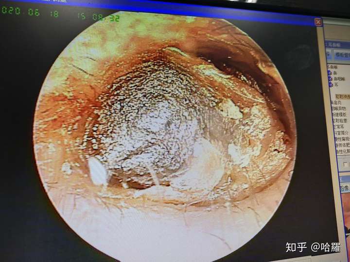 耳屎能大到什么程度?