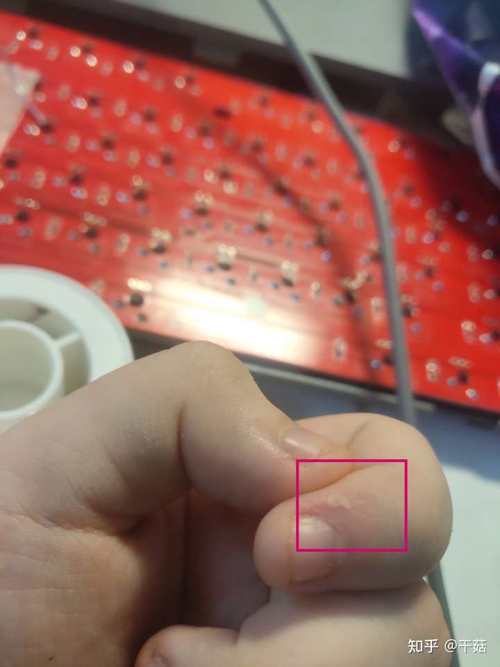 被电烙铁烫伤是一种什么样的体验?怎么处理不易留疤?