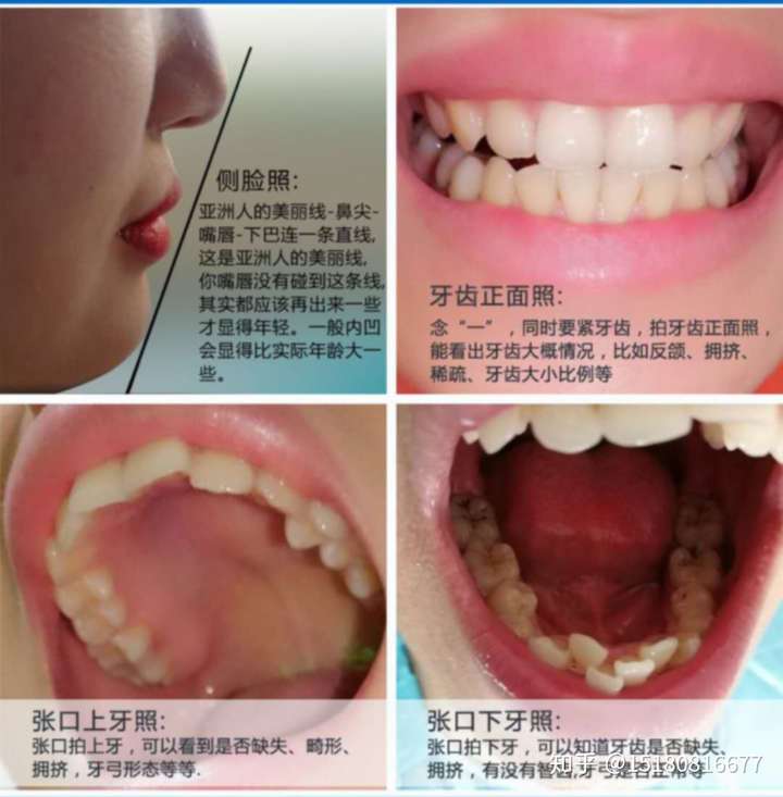 牙齿拥挤,导致有几颗牙齿内陷.