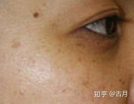 怎样确定脸上的斑是什么斑?