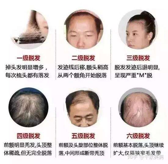 1,脂溢性脱发: 这种情况医学上称之为雄性脱发,多是由于体内雄激素
