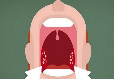 口臭喉咙异物感68可能是扁桃体结石教你2招自行清除结石