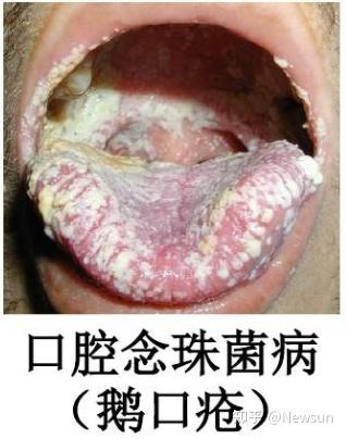 口腔念珠菌病在hiv感染者的口腔损害中最为常见,常表现为红斑型或