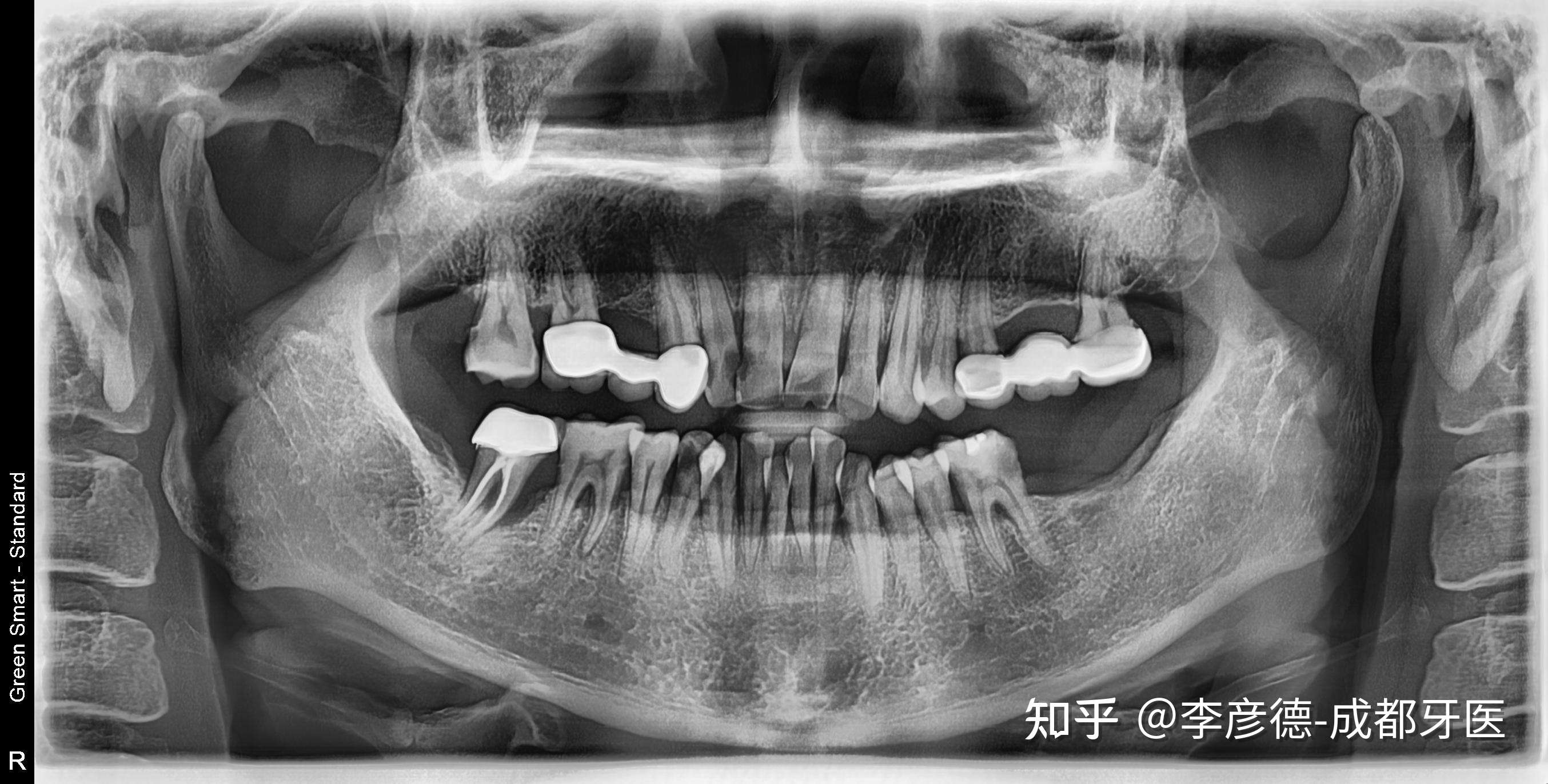 李彦德-成都牙医 的想法#种植牙 四张图,横跨一年[悠闲]后牙区