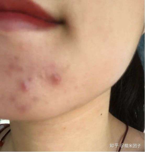 为什么长痘时候,这个痘痘摸起来硬硬的,好像里面有硬块一样,那是什么
