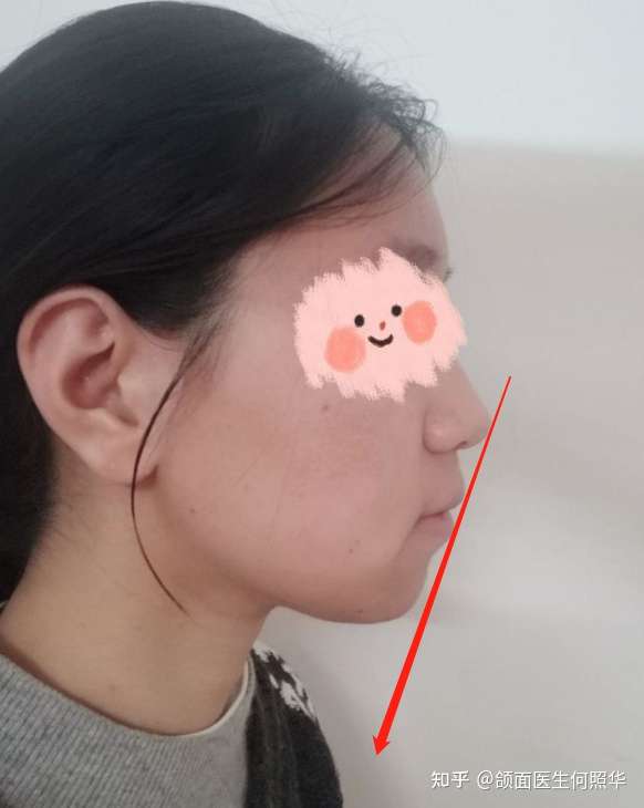 从图上看,题主下巴短且后缩,显得嘴略.