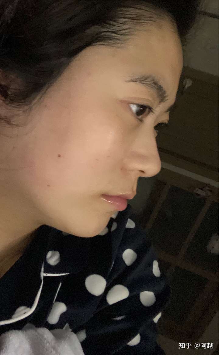 侧面看眼睛非常突,眉骨低和鼻子连接不起来是怎么回事?