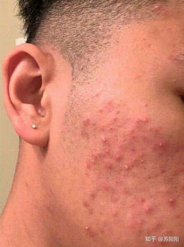 脸上长痘痘反反复复,该怎么办?